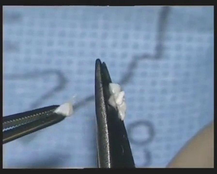 CO2 Laser Stapedectomy