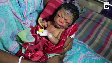 Quand les médecins voient le bébé, ils retiennent leur souffle: il ressemble à un homme de 80 ans!