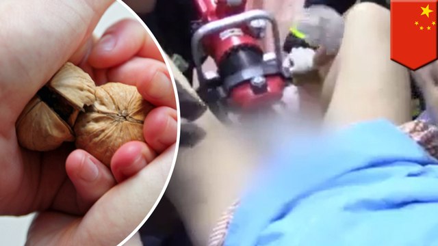 Man’s balls trapped in magnets: Painful accident during ‘magnet therapy’ in China - TomoNews