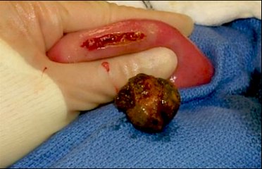 What Are Gallstones?
