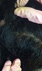 Horrible : cette femme a des centaines de poux dans les cheveux