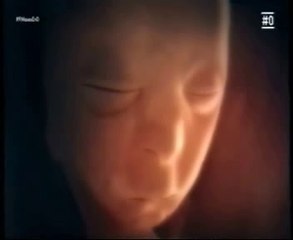Labio leporino: Cirugia reconstructiva