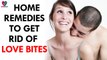 5 Home remedies to get rid of love bites- health Sutra