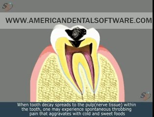 Root Canal Treatment Animated Movie