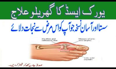Uric Acid ka ilaj, Uric Acid Treatment at home