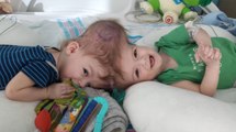 Başları Yapışık Doğan İkizler Ameliyat ile Birbirlerinden Ayrıldı