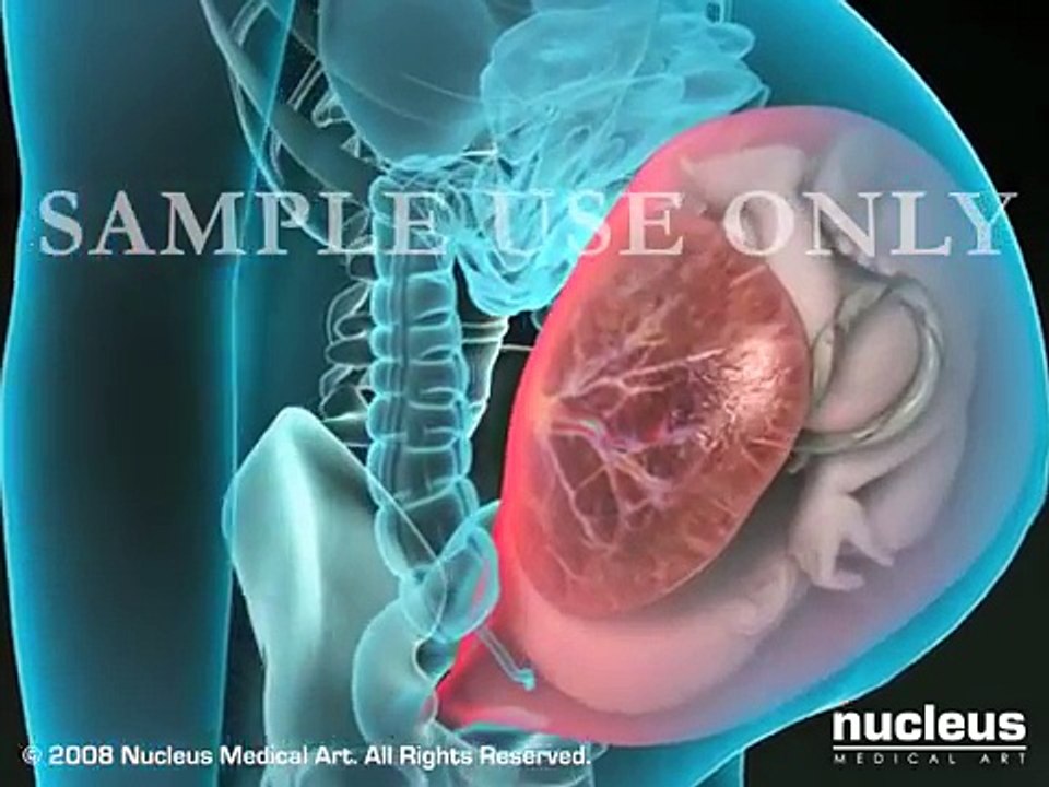 C-section (Cesarean Delivery)