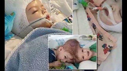 American Veena and Vani Got Separated