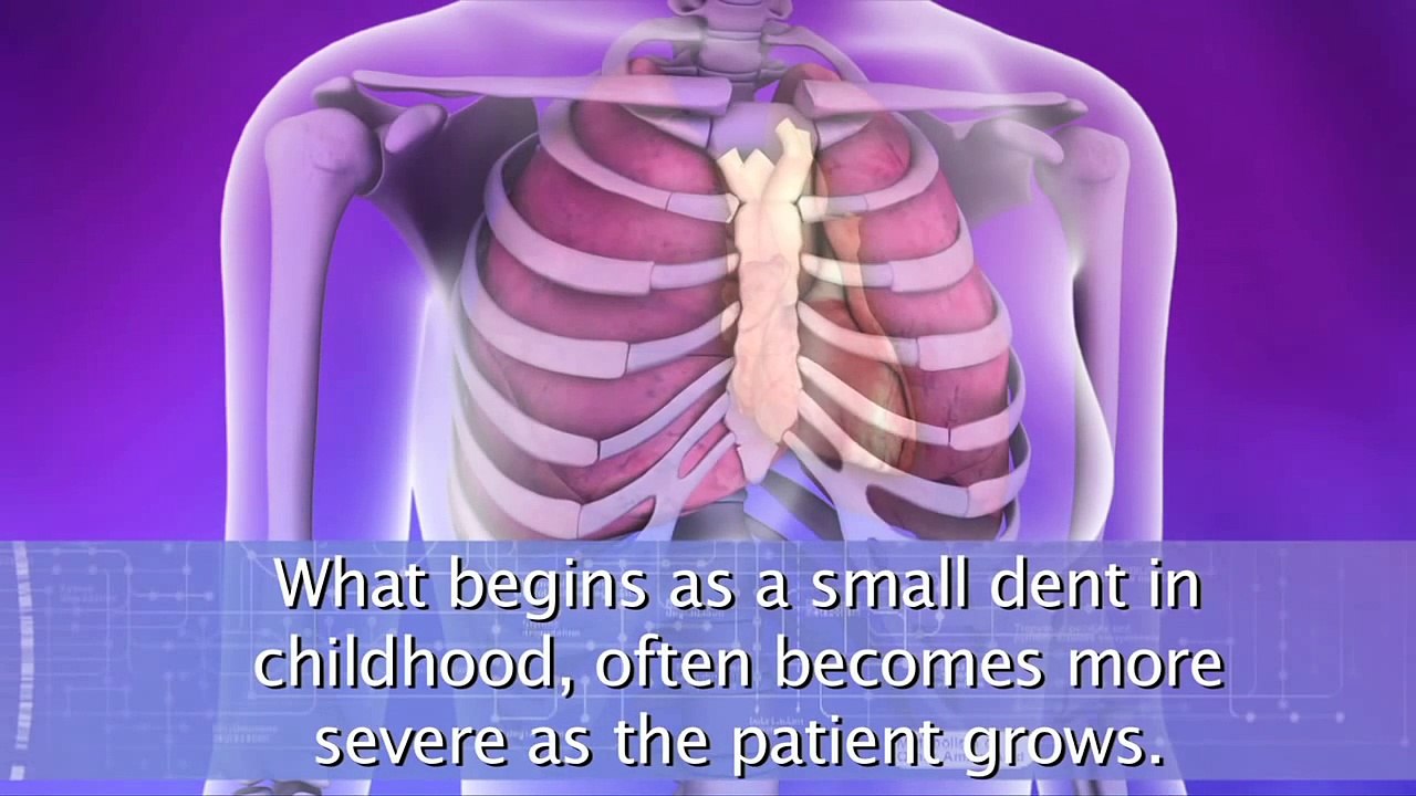 Pectus Excavatum Repair