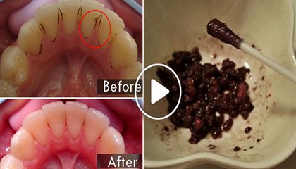 This Can Even Whiten Extremely Yellow Teeth And Remove That Nasty Plaque And Tartar Buildup