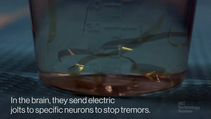 Terapia de alambres inyectables podría ser eficaz contra el Parkinson