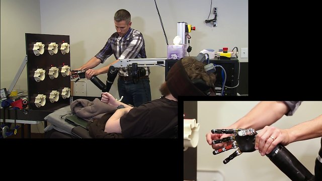 Implant cérébral : un tétraplégique retrouve le sens du toucher