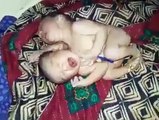 Miracle of Allah baby born with one body