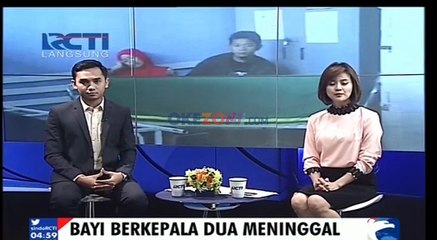 Bayi Kembar Siam Berkepala Dua Meninggal