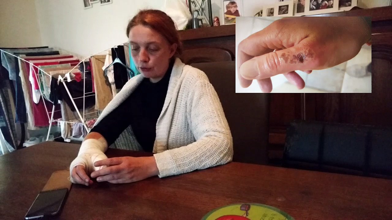 Mordue par une araignée, Séverine risquait l'amputation