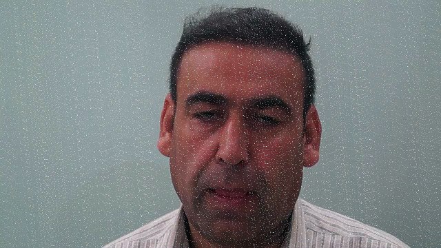 Afghanistan Patient 3100 Graft Hair Transplant Result with BIO-FUE Technique : AKClinics