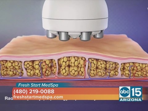 Fresh Start MedSpa offers Fusion Contouring