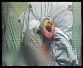 Epilepsia: Muerte subita (Autopsia forense)