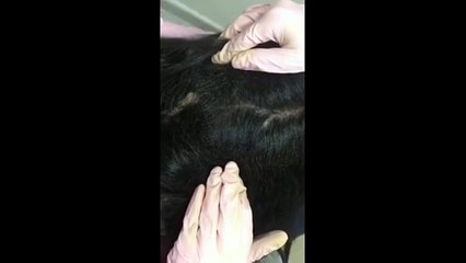 Hundreds of lice crawling in a girl's hair