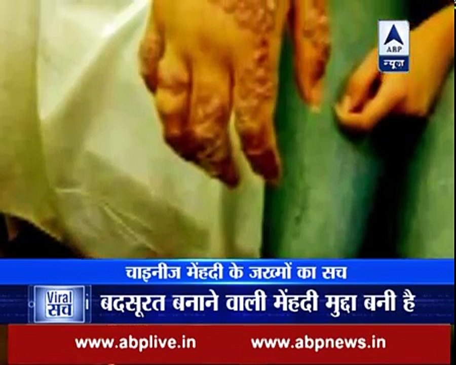 Does Chinese Henna cause skin ailments