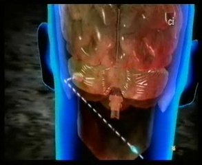 Suicidio cerebral: Autopsia forense (Un tiro en la nuca)