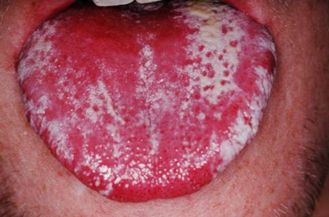 Mouth Fungus Infection