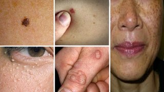 How To Naturally Cure Age Spots, Skin Tags, Moles, Warts, And Blackheads