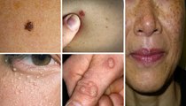 How To Naturally Cure Age Spots, Skin Tags, Moles, Warts, And Blackheads