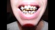 Wear Your Retainer After Adult Braces! -Before and After Transformation Pictures-