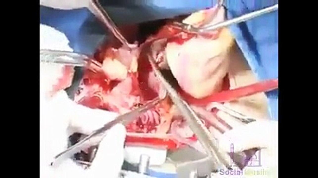 Open Heart Surgery