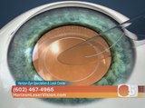 Horizon Eye Specialists & Lasik Center has new vision options for cataract patients
