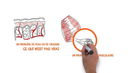 Comment Eliminer la Cellulite Définitivement - Anti cellulite