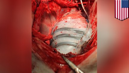 Harvard researchers develop robotic sleeve for failing hearts