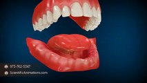 SubPeriostial Implant for Bone Loss in the Jaw - Dental Surgical Procedure | 3D Medical Animation