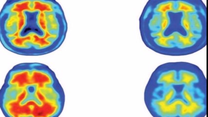العلماء يتوصلون لعلاج جديد لمرض ” الزهايمر “