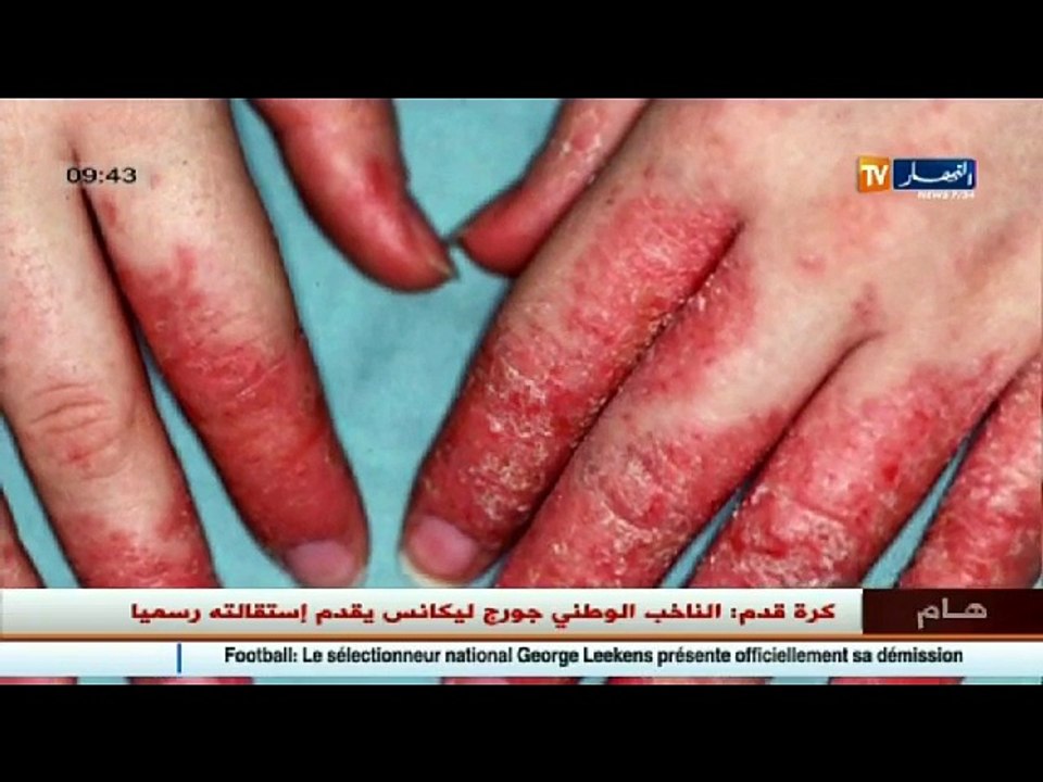 3 دقائق صحة   الإكزيما  لدى النساء..الأسباب و ا...