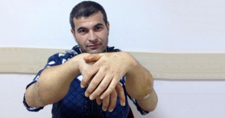 Ülkenin 4. Çift Kol Nakillisi Mustafa Sağır Bardak Tutabiliyor