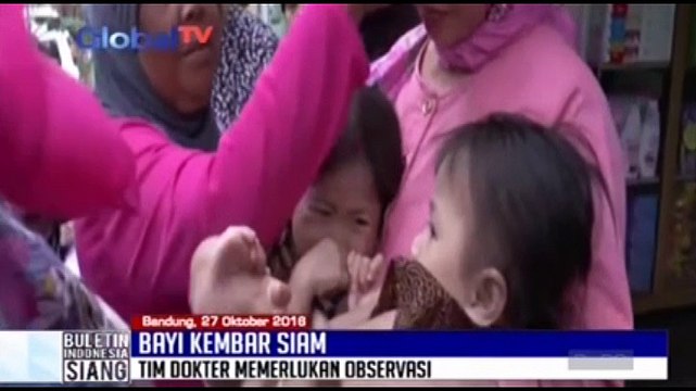 Dokter Lakukan CT Scan Bayi Kembar Siam