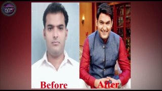 Kapil Sharma's SHOCKING HAIR TRANSPLANT!