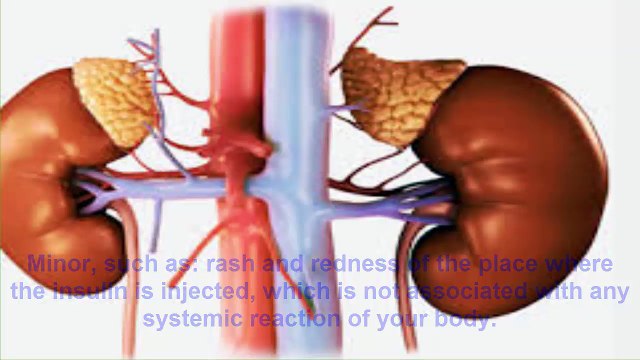 What Is Diabetes ► How To Cure Diabetes Without Medicine Naturally ► SHOCKING TRICK ► CERAGEM