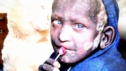 Fenomena Aneh! Bocah ini perlahan berubah menjadi Batu Mengerikan bikin Keluarga PANIK