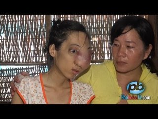Nhà nghèo không tiền chữa bệnh, cô sinh viên bị khối u phá hủy gương mặt
