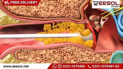 WaxVac Ear Wax Removal in Pakistan - www.zeesol.net