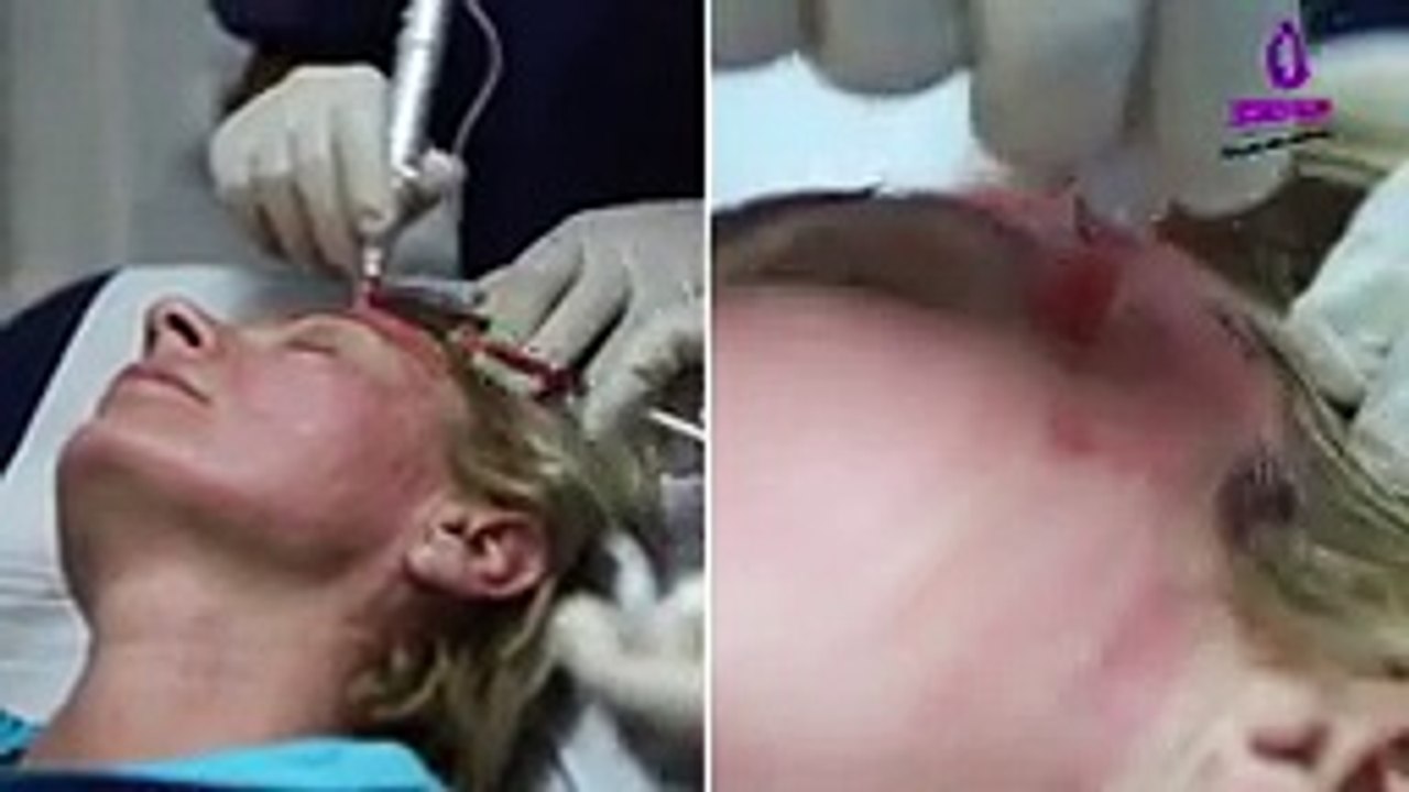 Microneedling