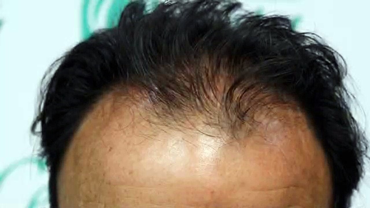 CLINICAS CETA CAPITAL www.injertodepelo.es