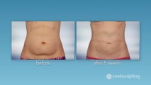 Coolsculpting - Eliminate stubborn fat without surgery  | Fat-Freezing Fat Reduction Procedure | Dansys Medical Group