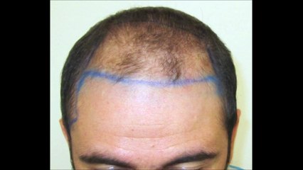 Op. Dr. Zekeriya KUL - Trasplante De Pelo (Implantación con Aguja)