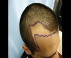 Op. Dr. Zekeriya KUL - Hair transplantation Needle Implantation Technique 1600 Greft