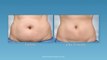 Coolsculpting - Fat-Freezing Fat Reduction Procedure | Dansys Medical Group