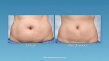 Coolsculpting - Fat-Freezing Fat Reduction Procedure | Dansys Medical Group